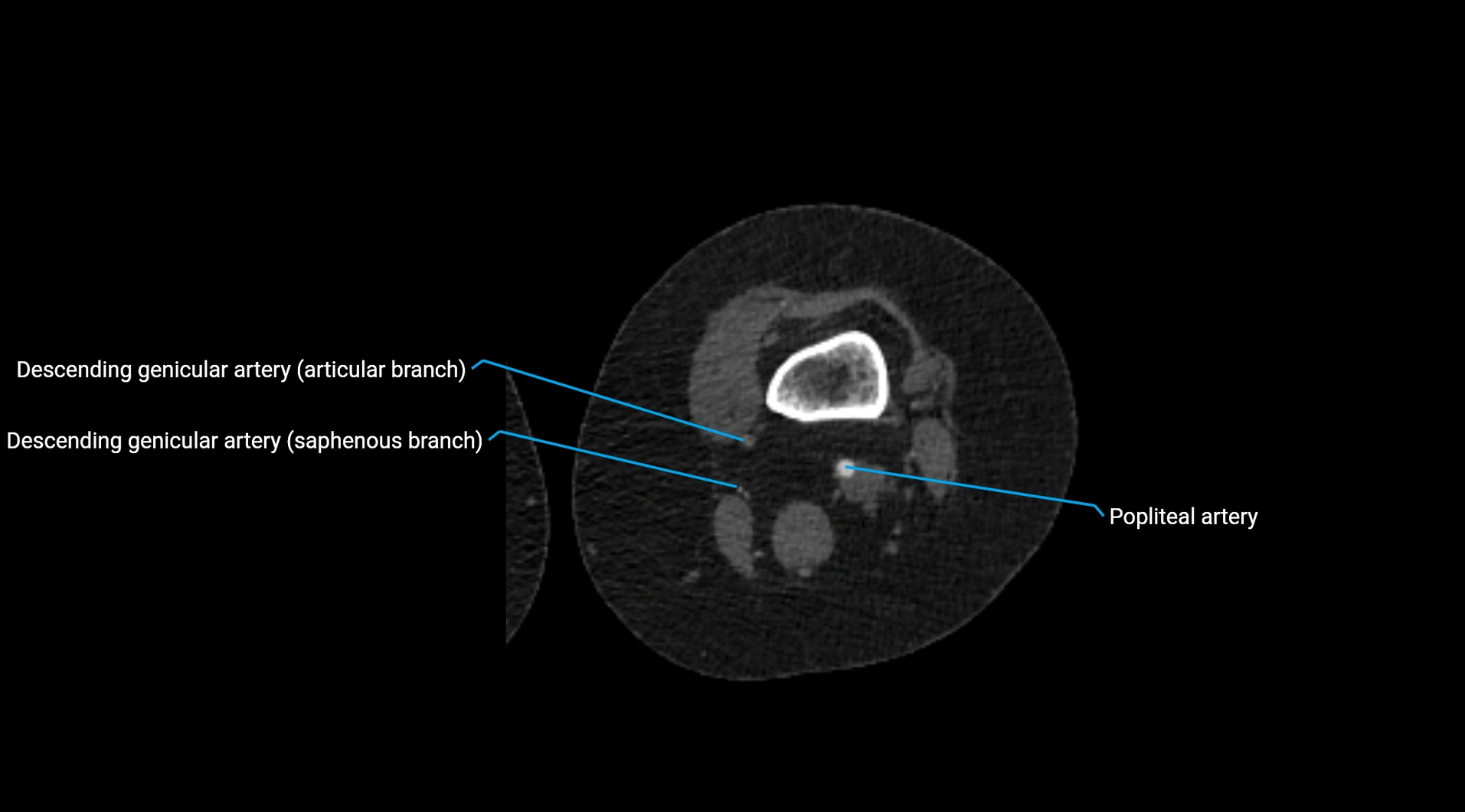 CTA lower limb cross sectional anatomy labelled image _163.webp